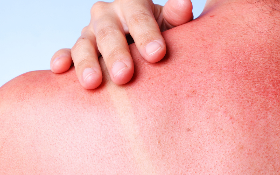 How to Choose the Right Sunscreen for Your Skin Type | Best SPF for Acne-Prone, Sensitive & Dry Skin