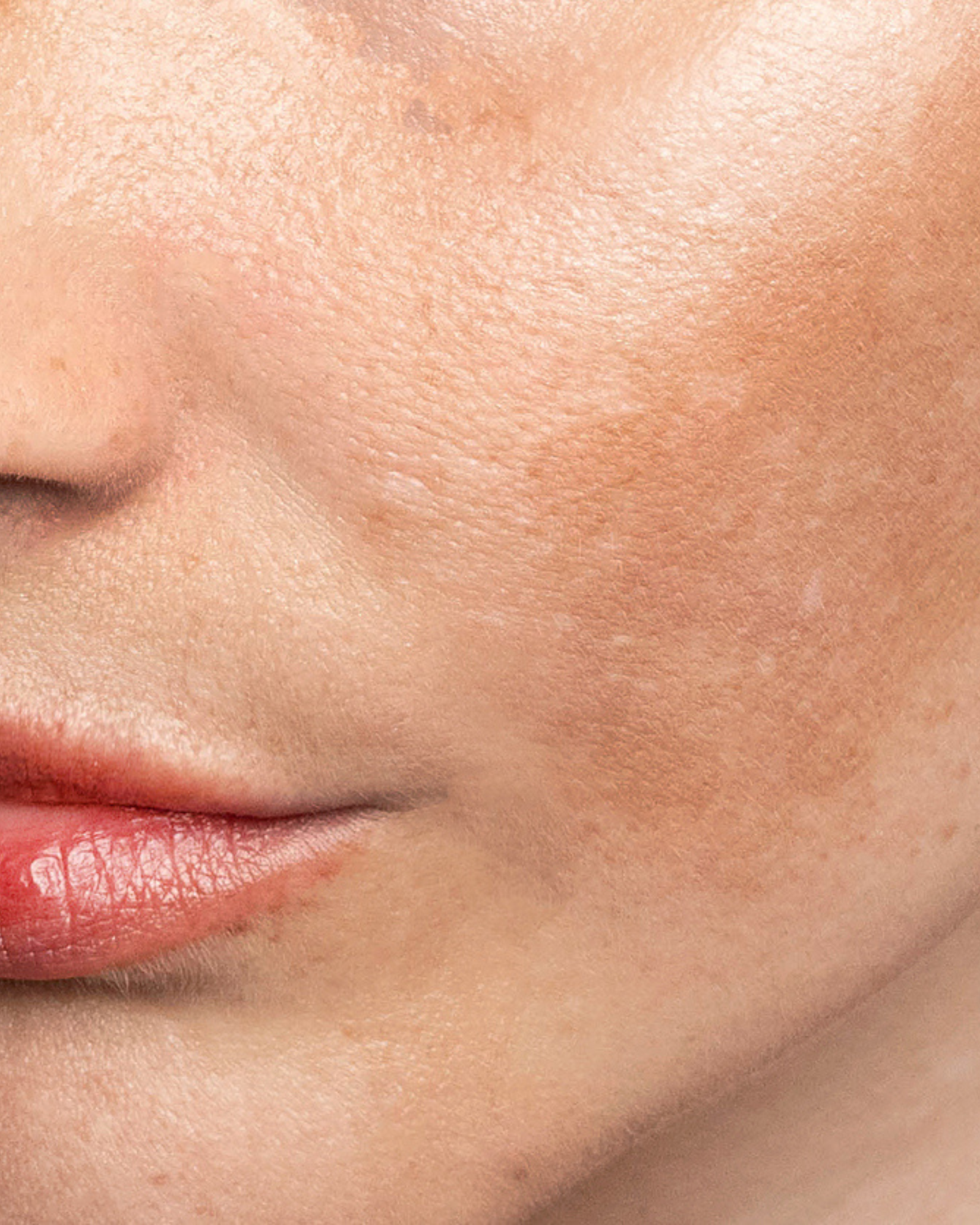 Melasma vs. Sun Spots vs. Age Spots: How to Tell Them Apart